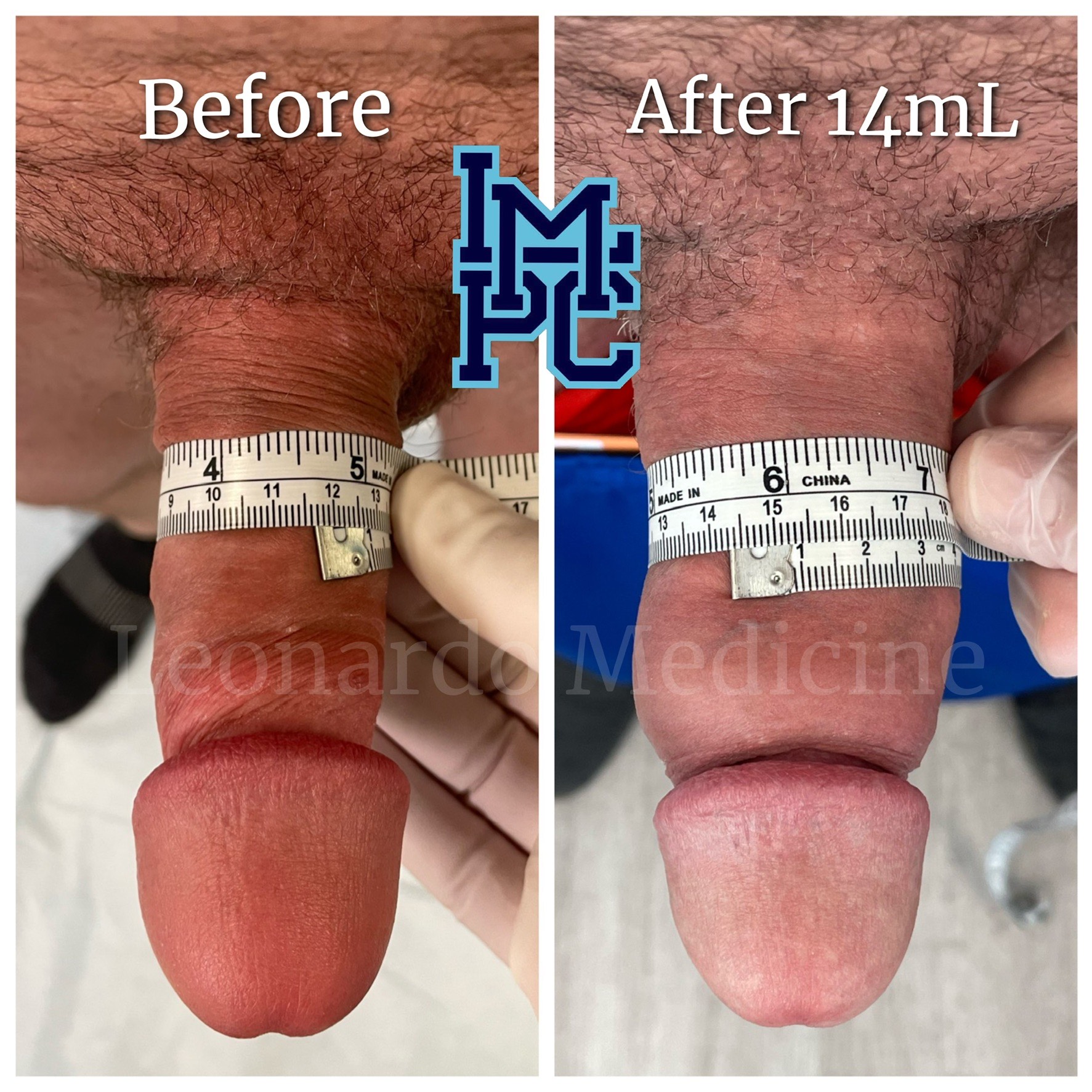 14mL2