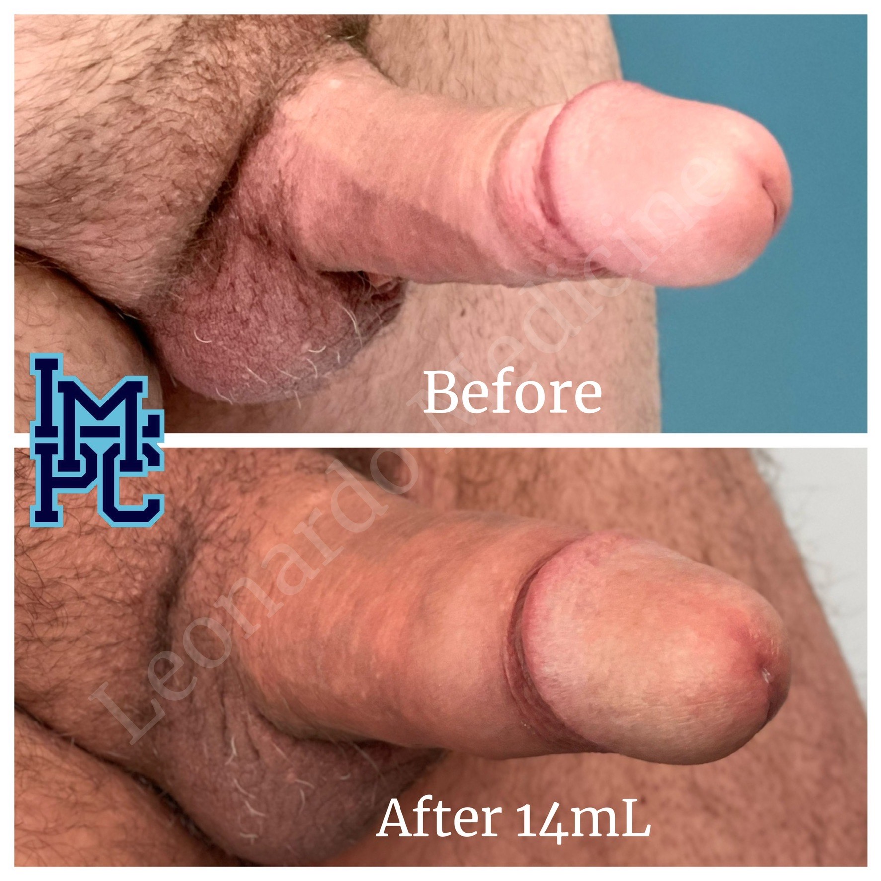 14mL3