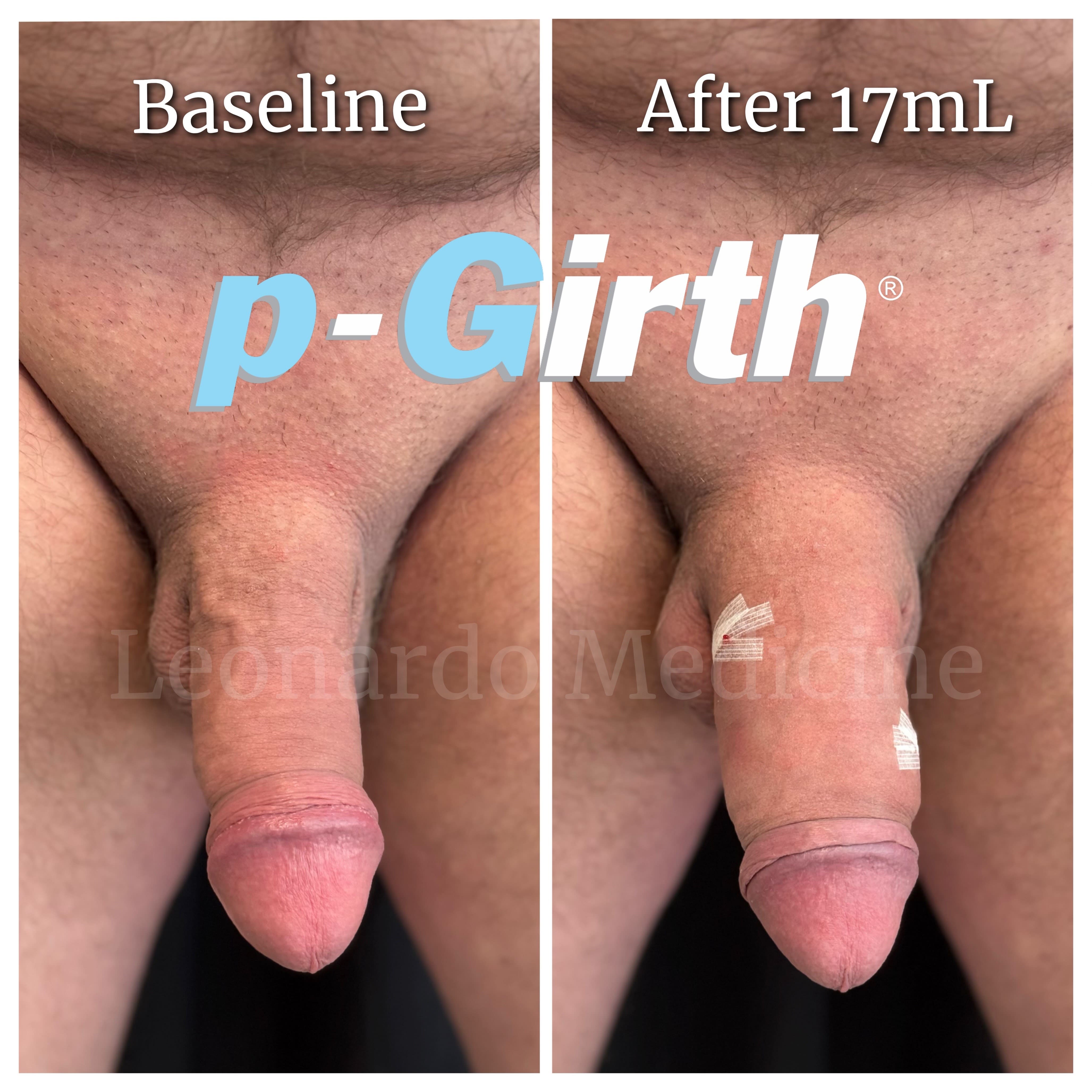 17ml1 min