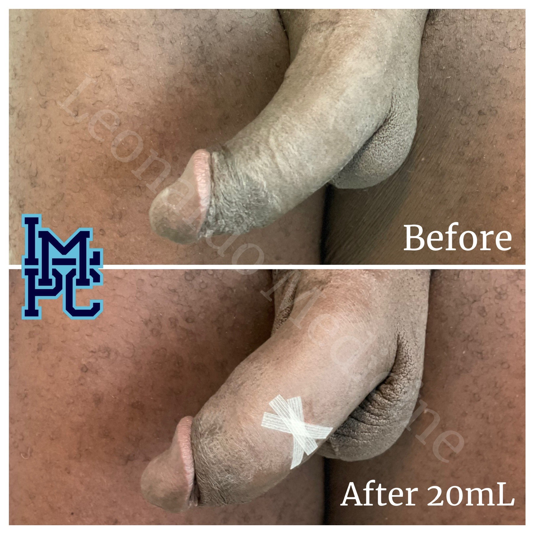 20mL1