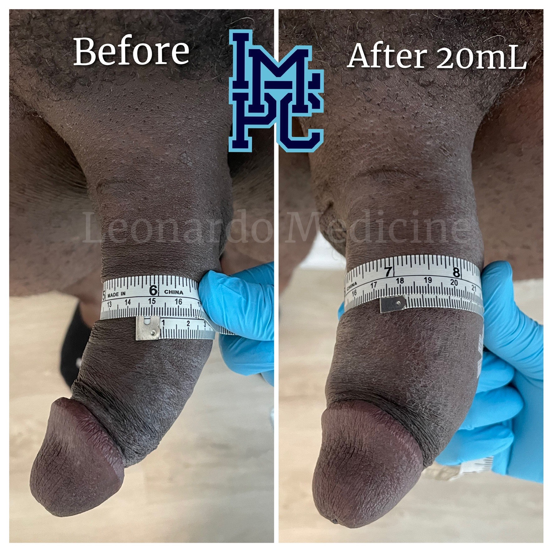 20mL2