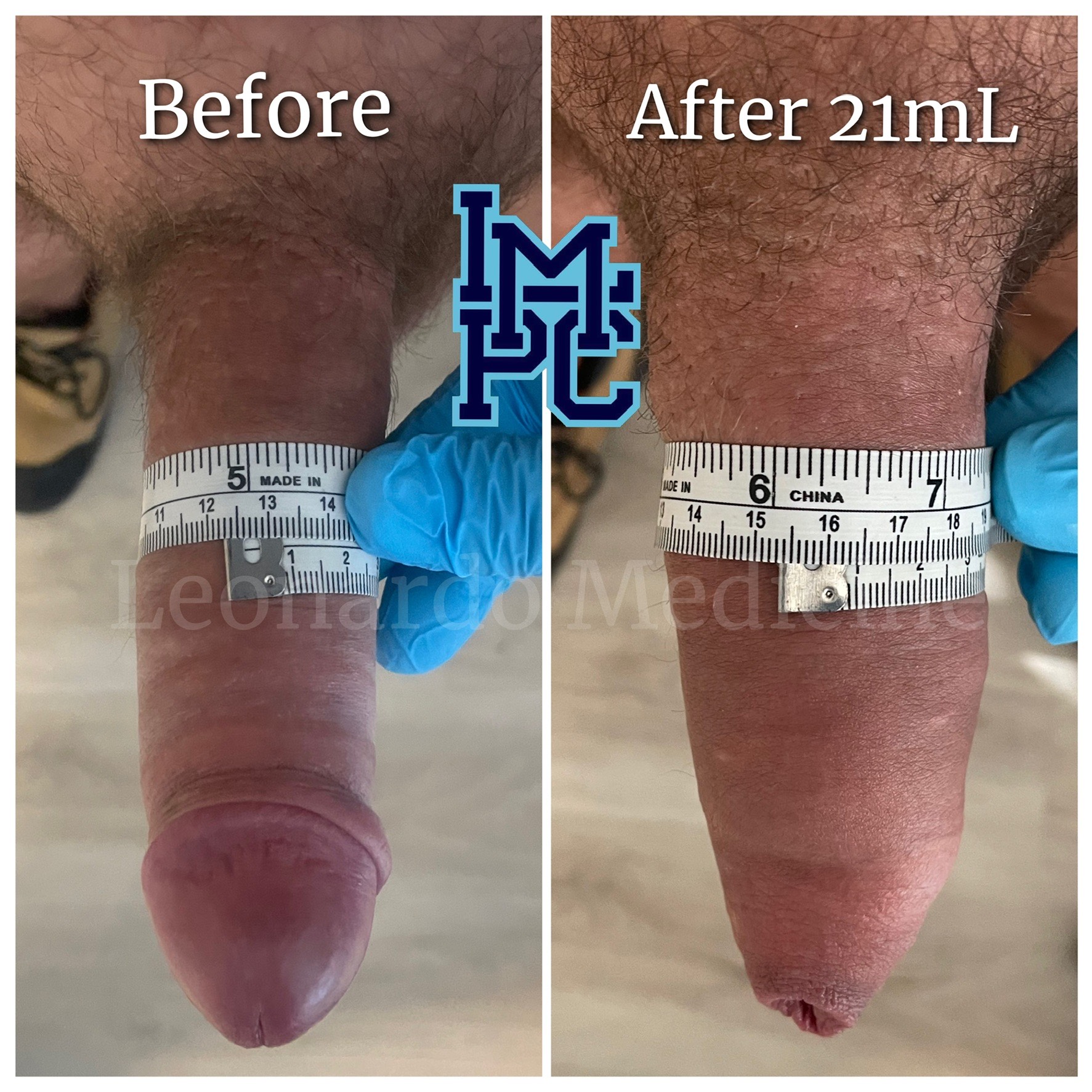20mL5