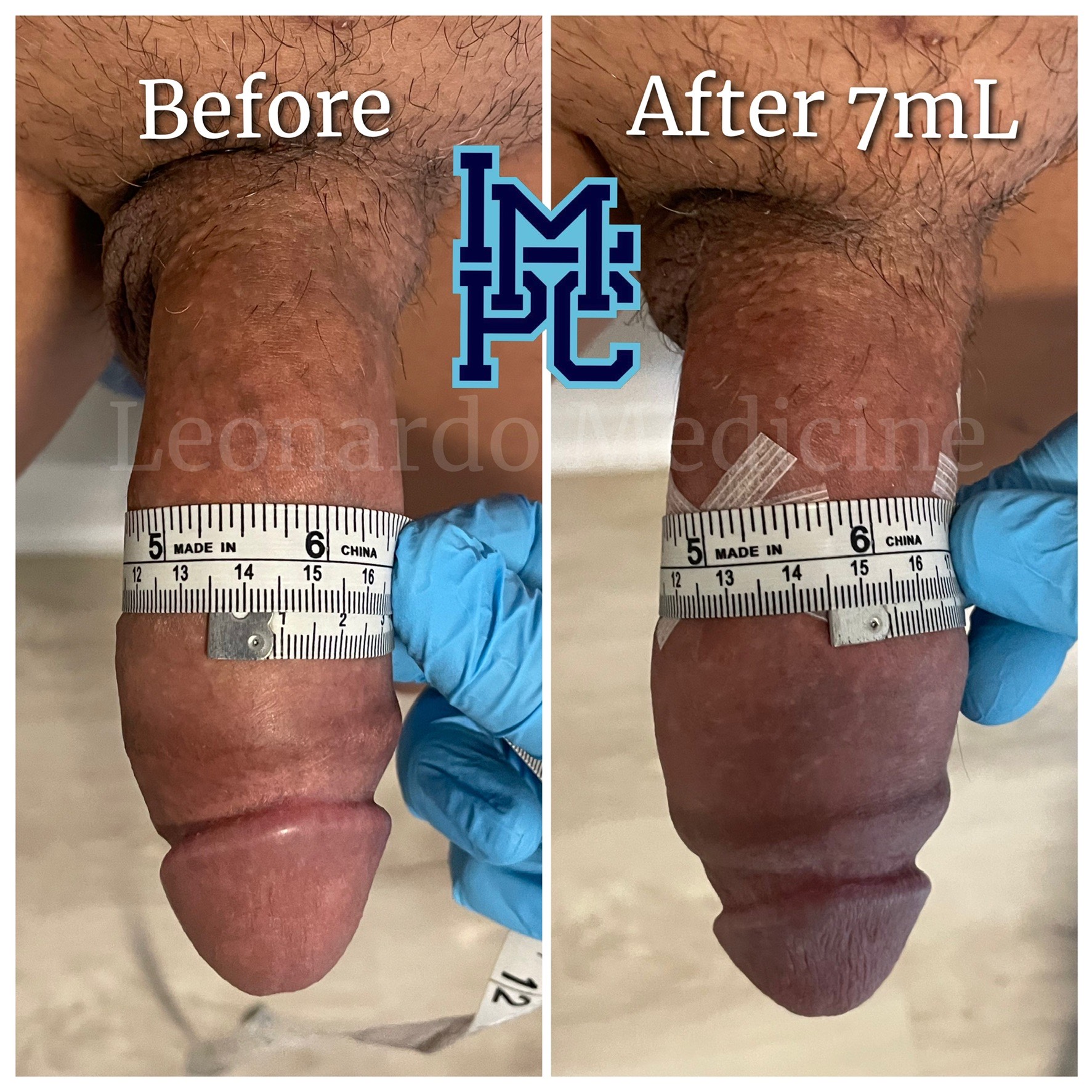 7mL2