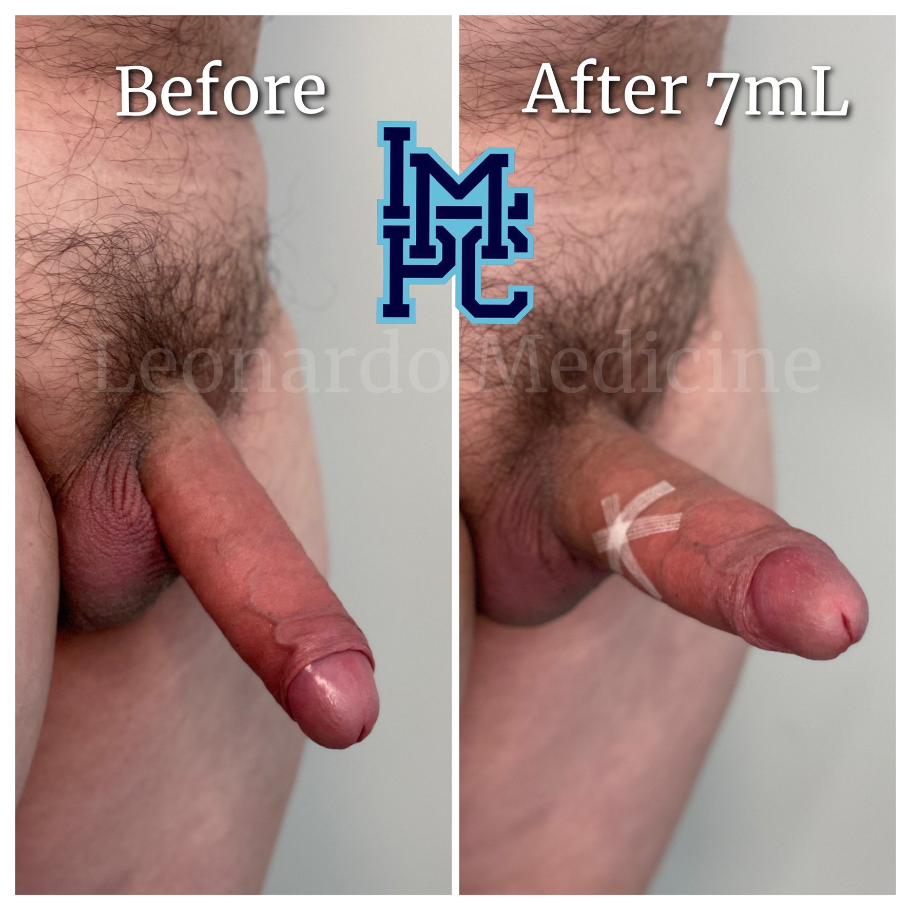 7ml1