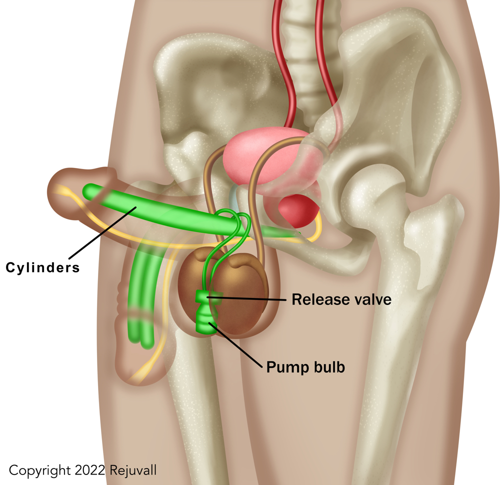Penile Prosthetic Implant 1000