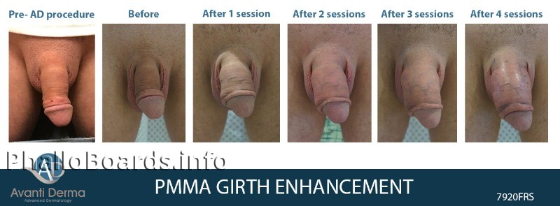pmma.4sessions